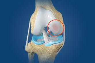 Arthroscopic Chondroplasty