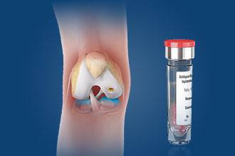 Cartilage Cell Implantations