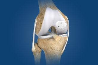 Knee Cartilage Restoration