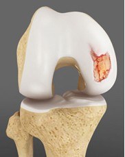 Cartilage Damage