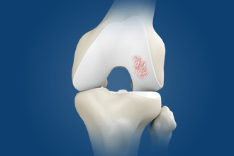 Cartilage Transplantation