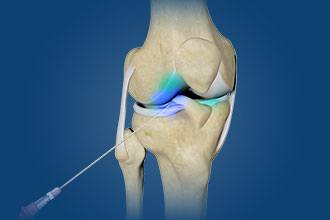 Intra-Articular Joint Injections