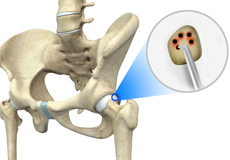 Cartilage Microfracture