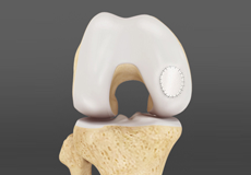 Cartilage Transplantation