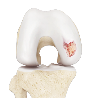 Cartilage Degeneration