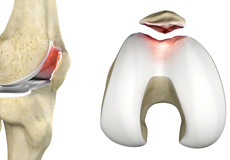 Chondromalacia Patella