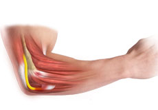 Cubital Tunnel Syndrome