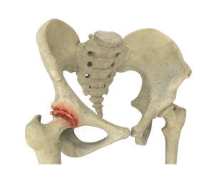 Osteoarthritis