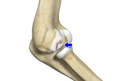 Osteochondritis Dissecans of Elbow