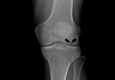 Osteonecrosis of the Knee